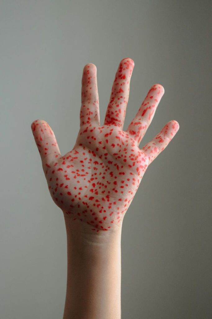 México registra 3,730 casos y 12 muertes por sarampión en menos de un mes