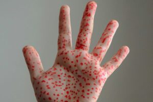 México registra 3,730 casos y 12 muertes por sarampión en menos de un mes